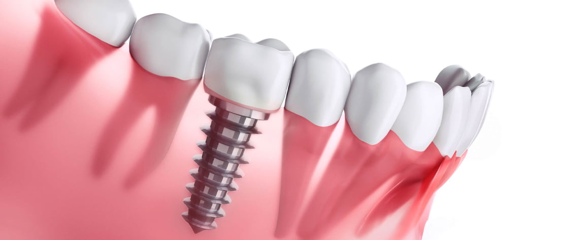 Dental Implants in Turkey