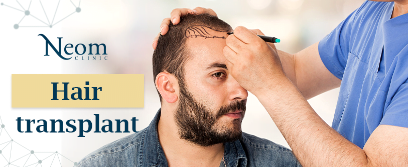 hair transplantation in Turkey زراعة الشعر في تركيا