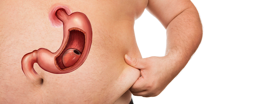 Gastric sleeve 