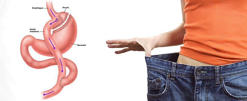 Gastric bypass