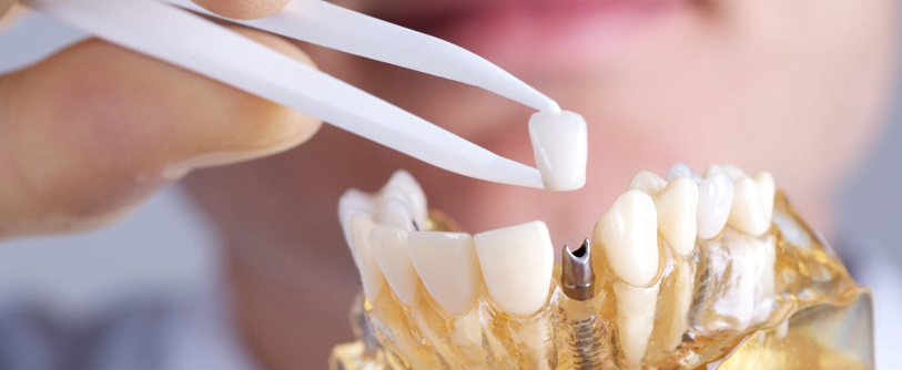 Dental Crowns تيجان الأسنان