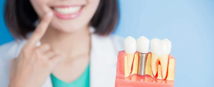 Dental Implants زراعة الأسنان