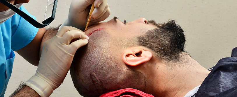hair transplantation in Turkey زراعة الشعر في تركيا