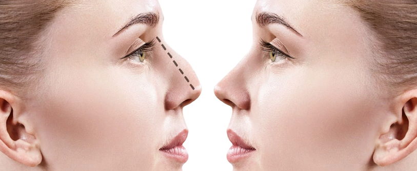 Rhinoplasty 
